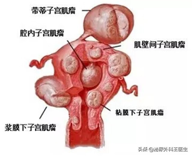 切除子宫 影响(子宫切除会影响什么)