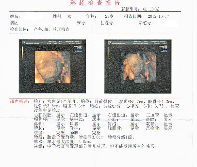 思维彩超(做四维彩超)