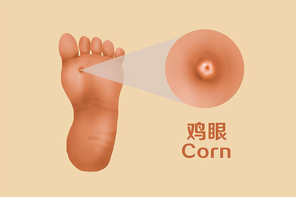 脚上有鸡眼怎么办呢(脚上长了鸡眼怎么处理)