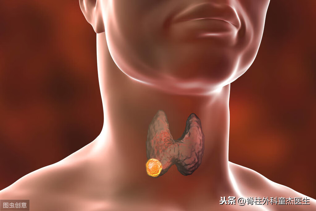 甲状腺肿瘤症状和反应(甲状腺癌的典型症状)