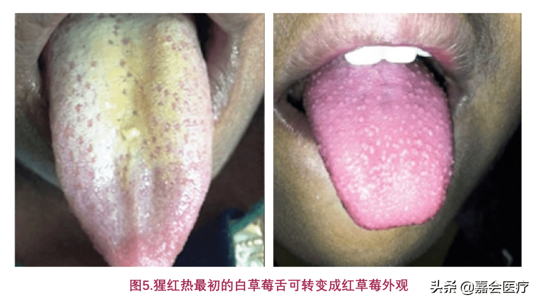 艾滋病的初期症状舌头(艾滋病发病期舌头症状)
