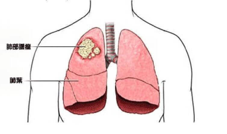 什么是非小细胞肺癌?(非小细胞肺癌是什么情况)