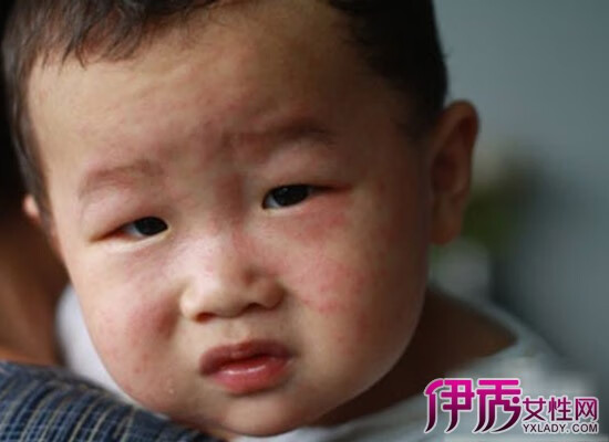 婴儿脸上起小红疙瘩是什么(婴儿宝宝脸上起红疙瘩)