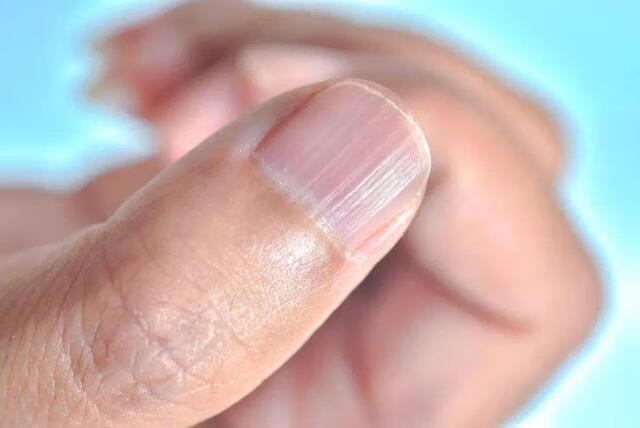 指甲上都是竖纹是什么原因?(十个手指甲上都有竖纹)