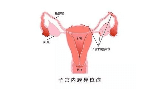 子宫内膜异位症有什么症状表现(子宫内膜异位症的症状)