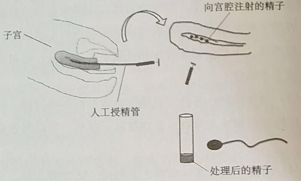 供精人工授精费用(人工授精的全部过程)
