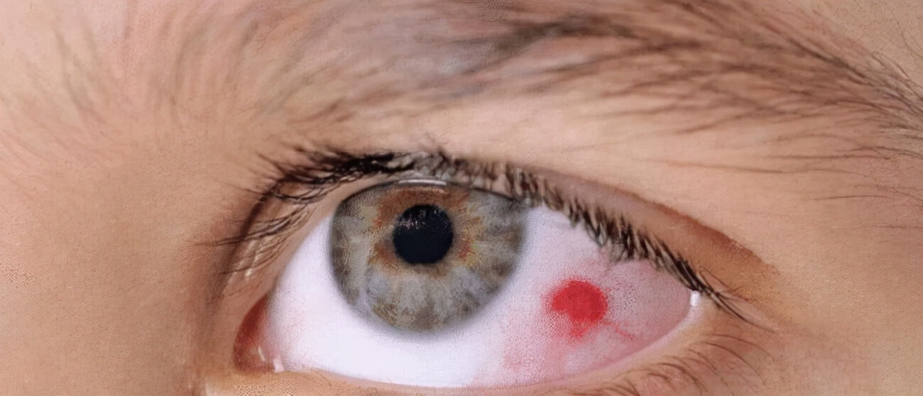 眼球充血是什么原因造成的(眼底充血是怎么回事)