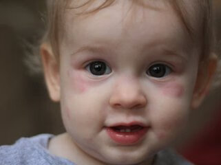 3岁宝宝荨麻疹怎么办(宝宝得了荨麻疹怎么治疗)