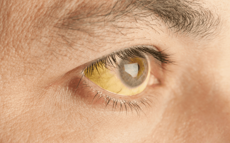 1,脸色暗淡,皮肤,虹膜发黄肝脏受损后,会导致人体的胆红素沉积到体内