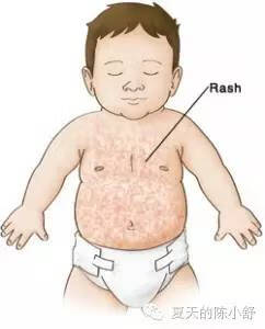 幼儿急疹的症状和表现(幼儿急疹的症状图片)
