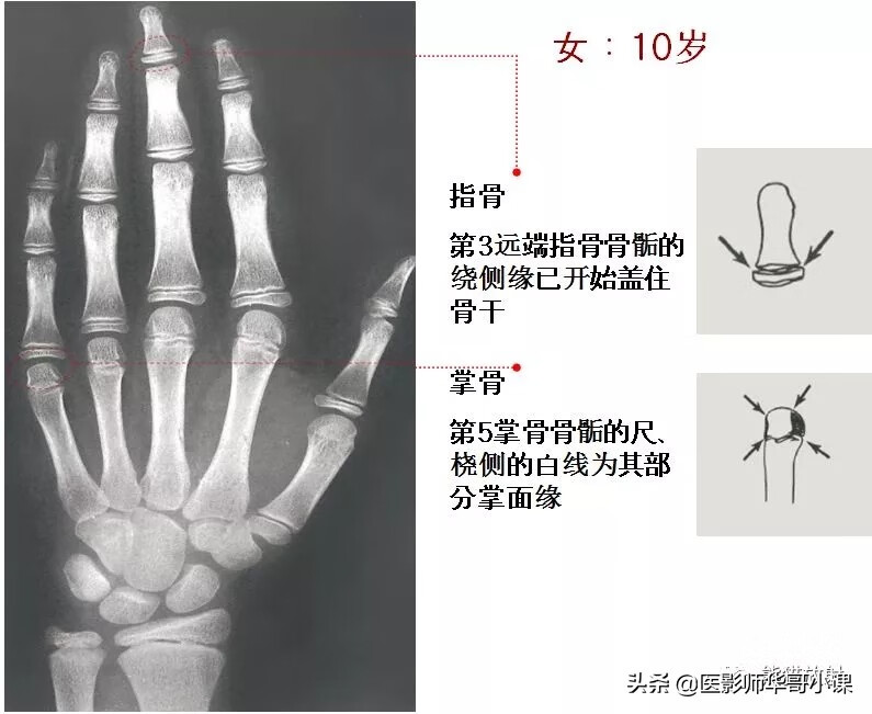 怎样测骨龄?(测骨龄的最佳年龄)