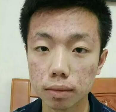 青春期痤疮一般到什么年龄结束(青春期痘痘一般几年)