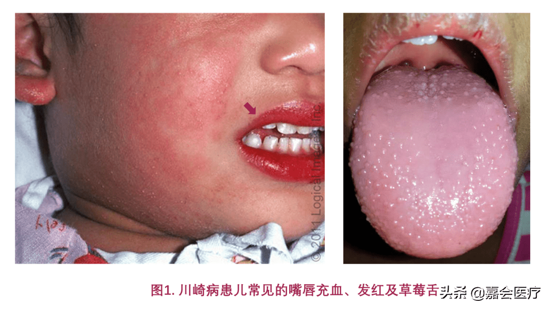 艾滋病的初期症状舌头(艾滋病发病期舌头症状)