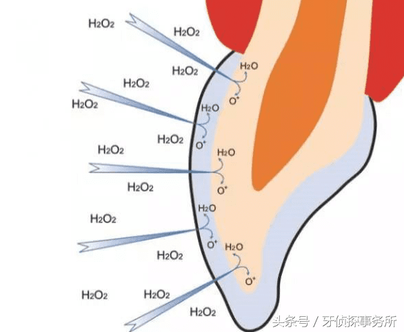 冷光牙齿美白原理(冷光美白对牙齿有伤害吗)