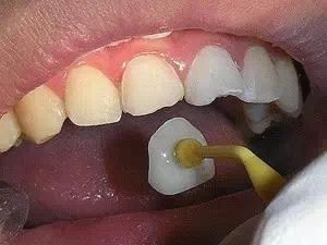 柠檬可以美白牙齿吗?(柠檬可以美白吗)