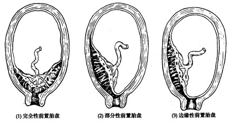 孕妇难产是什么原因引起的(孕妇难产怎么办)