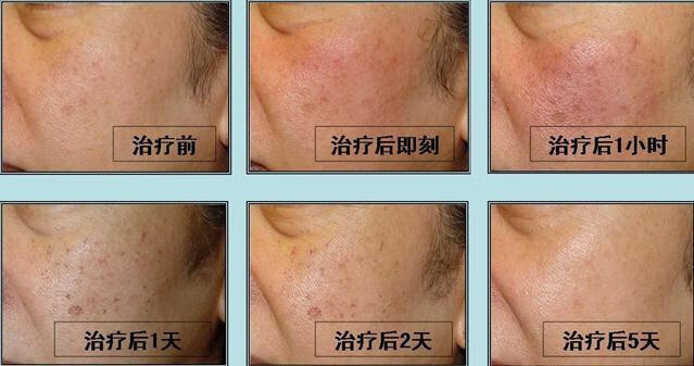 色斑的治疗(激光祛斑的费用大概多少)