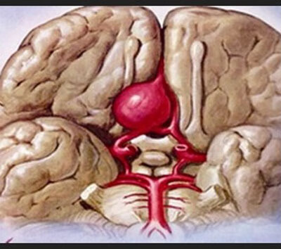 脑血管畸形是什么原因造成的(血管畸形严重吗)