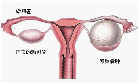 右附件囊肿怎么引起的(右侧附件囊肿怎么引起的)