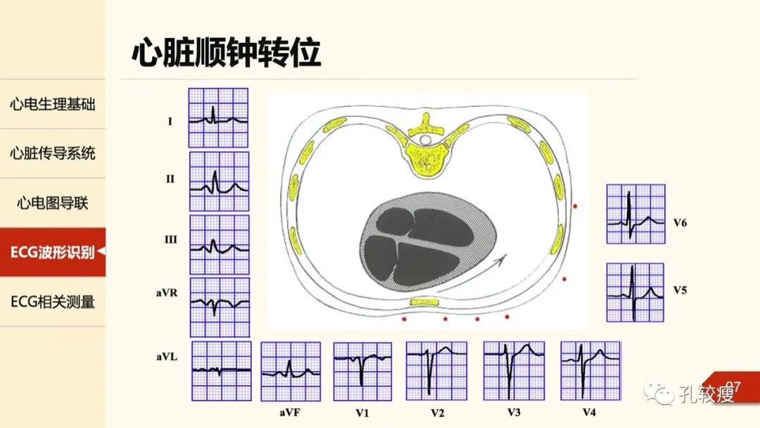 心电图导联位置示意图(心电图机导联位置图)