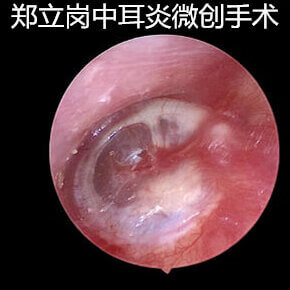 中耳炎费用一般多少(中耳炎治疗费用)