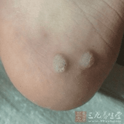 如何治疗鸡眼的方法