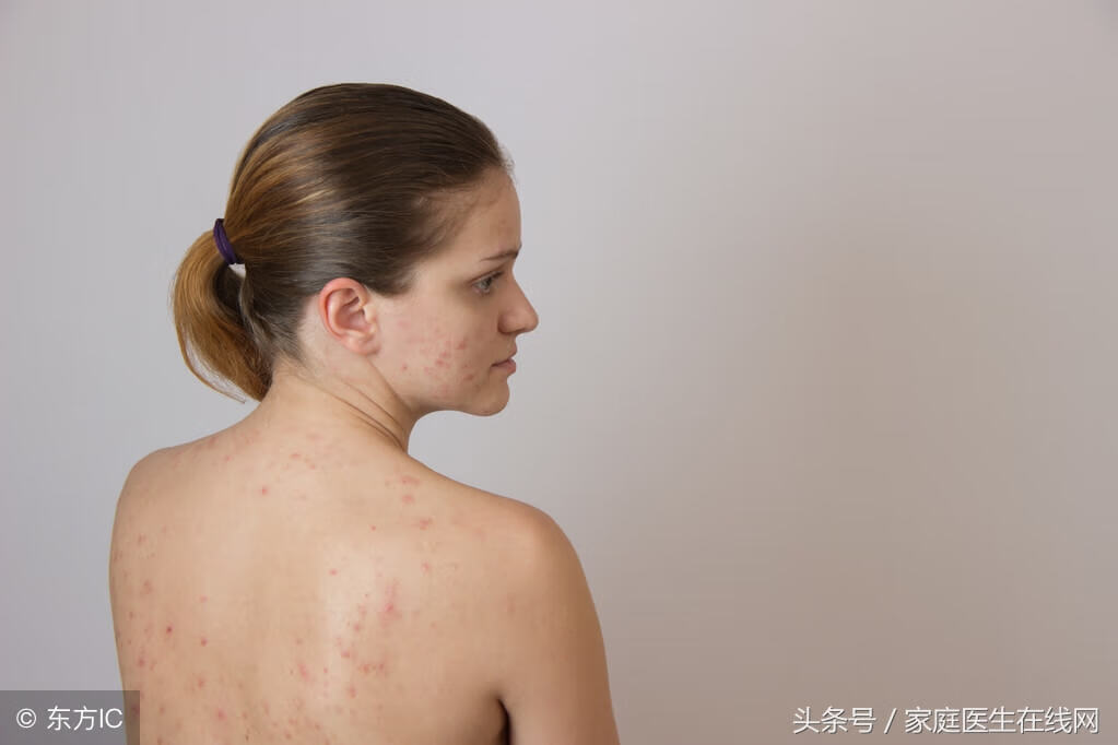 背上长痘痘怎么解决(背后一直长痘痘怎么治)