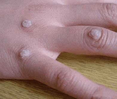 身上的瘊子传染吗(肉瘊子有传染性吗)