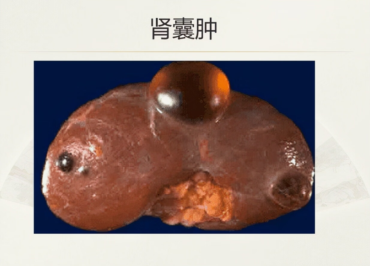 左肾囊肿是怎么引起的(女性为什么会左肾囊肿)