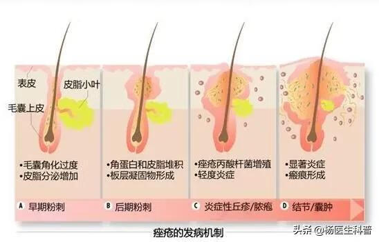 如何可以去除青春痘(脸上青春痘快速去除)