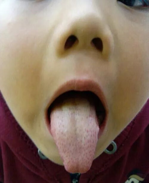 舌头上有红色的小肉粒是怎么回事(舌头表面上有红色的小肉粒)