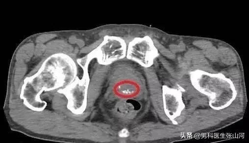 前列腺钙化灶是什么意思(前列腺钙化灶是什么原因)