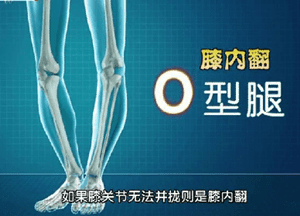 o型腿是什么原因造成的(o型腿的原因)