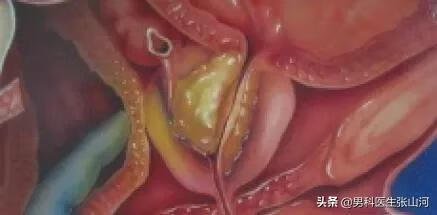 前列腺钙化灶是什么意思(前列腺钙化灶是什么原因)