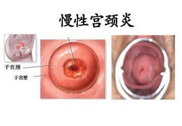 慢性宫颈炎 如何治疗(慢性宫颈炎怎么治疗最快)