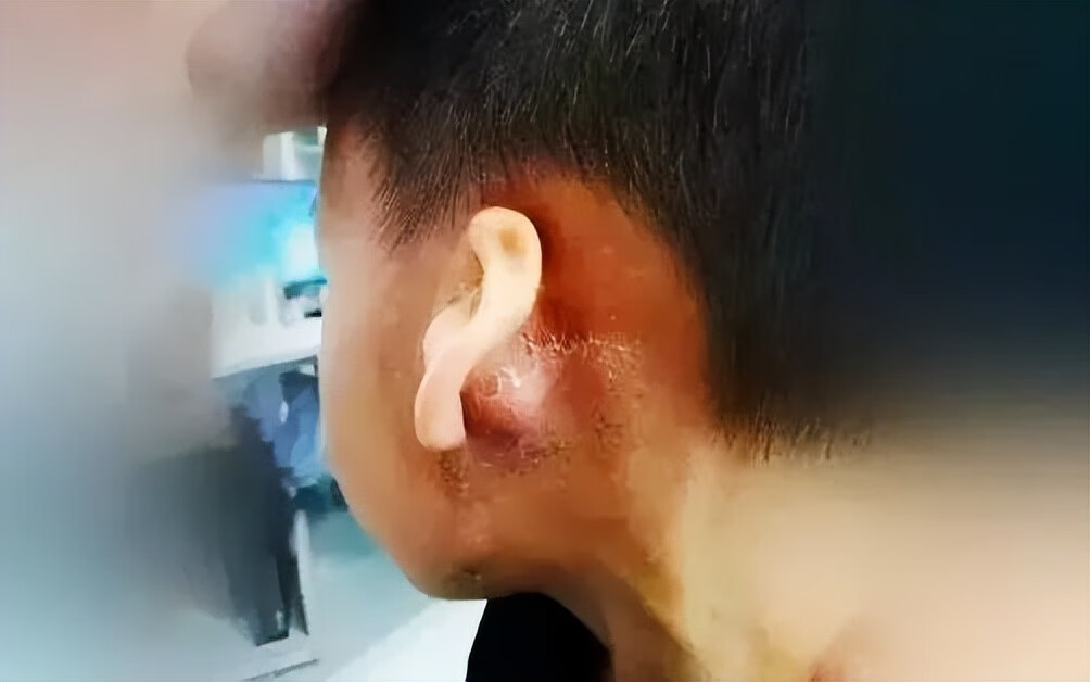 突然耳朵痛是什么原因(耳朵外廓痛是什么原因)