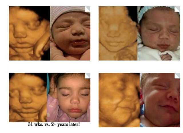 24周胎儿四维彩超图(孕期四维彩超图片)