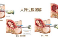 打胎的最佳时间是几个月