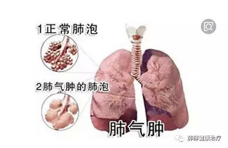 咳嗽气喘是什么原因(经常咳嗽气喘是怎么回事)