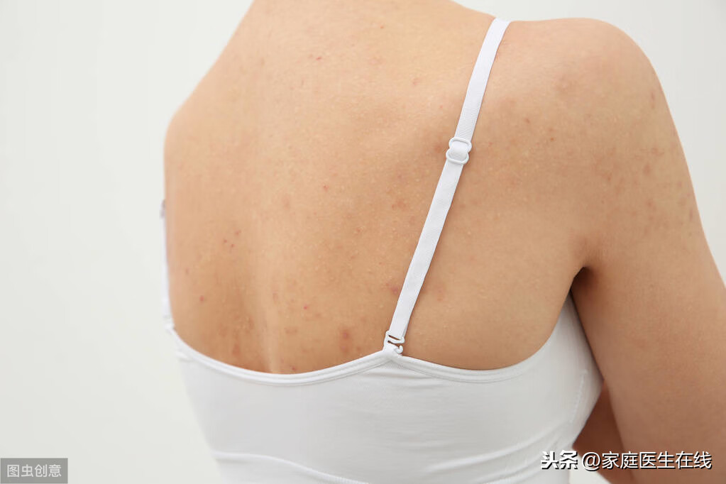 背上长痘痘的原因和解决方法(背部长痘痘什么原因)