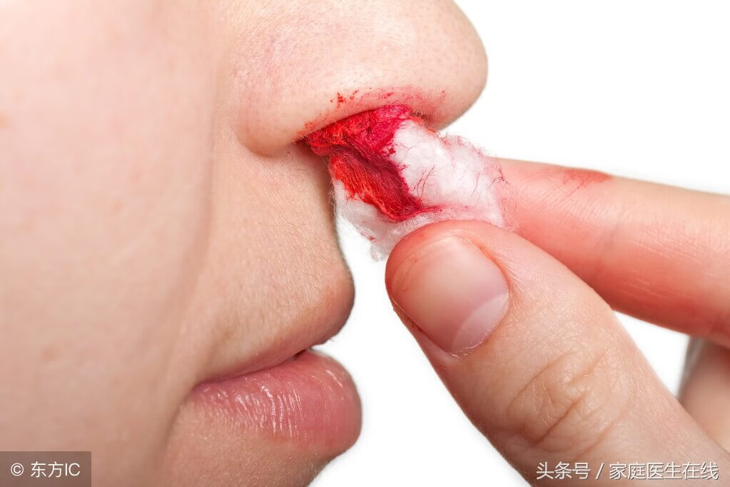 鼻子经常出血是什么原因怎么办(鼻子总出血是什么病征兆)