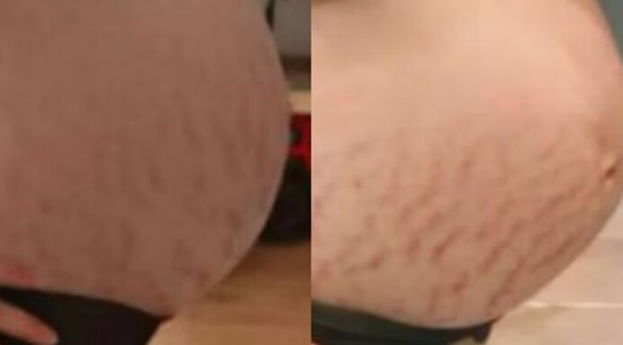 妊娠纹淡化过程(妊娠纹可以淡化到什么程度)