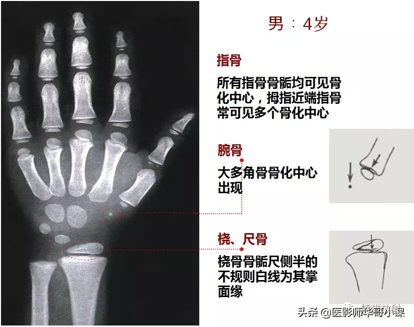 怎样测骨龄?(测骨龄的最佳年龄)