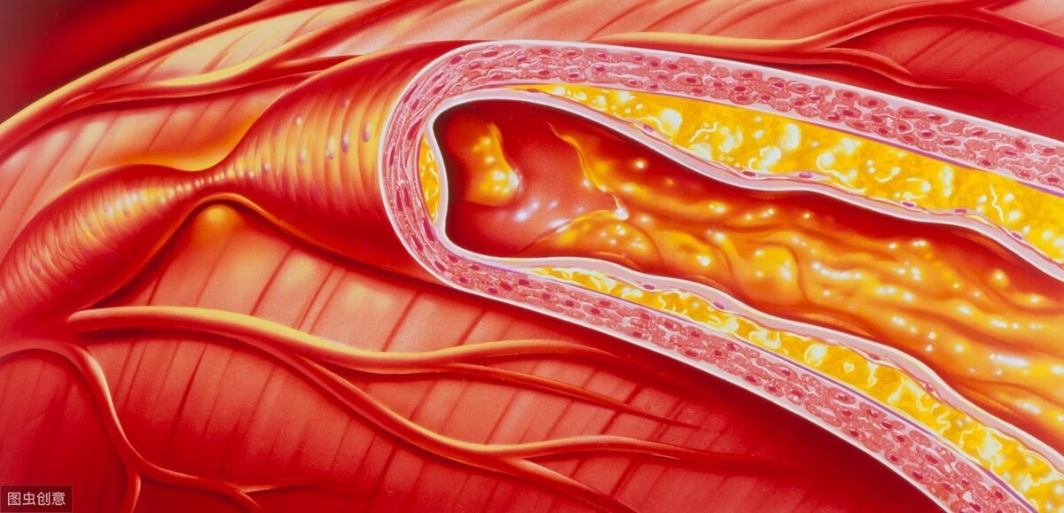 动脉粥样硬化真实图片图片