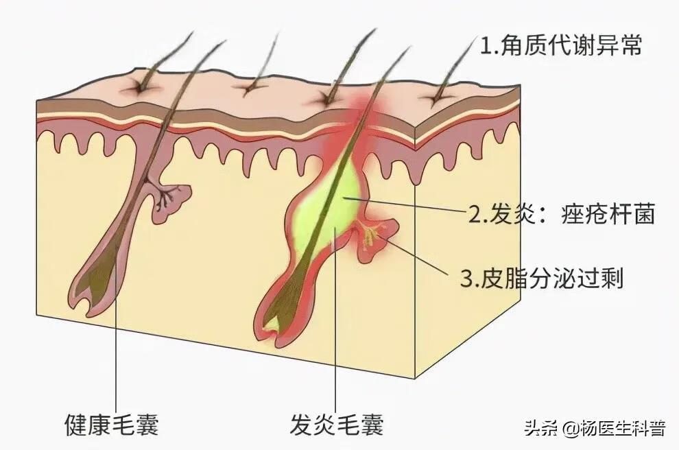 如何可以去除青春痘(脸上青春痘快速去除)