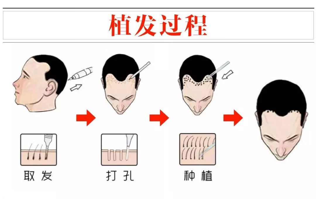 如何头发种植(种植头发的过程和步骤)