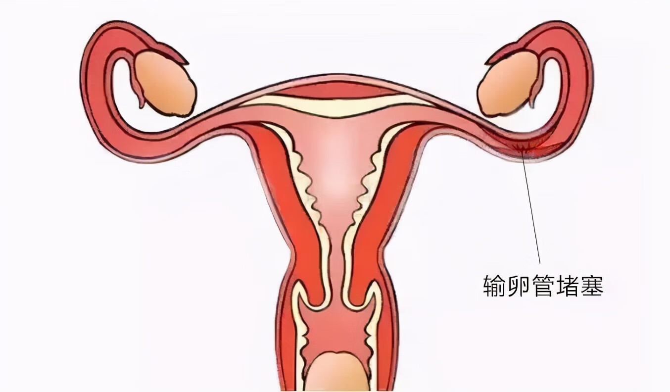 输卵管堵塞有什么样症状图片(如果输卵管堵塞有什么明显症状吗)