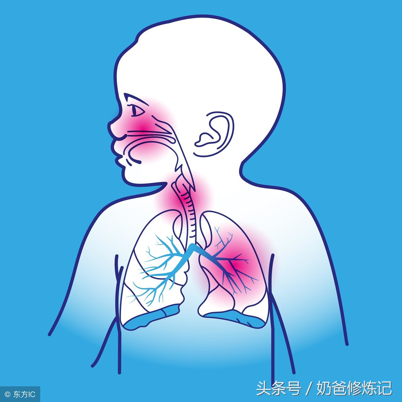 肺透明膜病又叫(肺透明膜形成是什么意思)