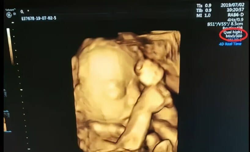 胎儿四维彩超性别照片(22周胎儿四维彩超图)