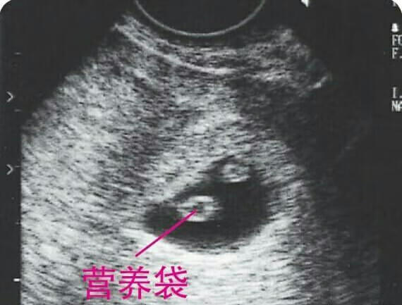 怀孕8个月胎儿b超图片(怀孕四个月b超图)